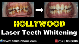 Hollywood laser teeth whitening cost review ahmedabd gujarat india