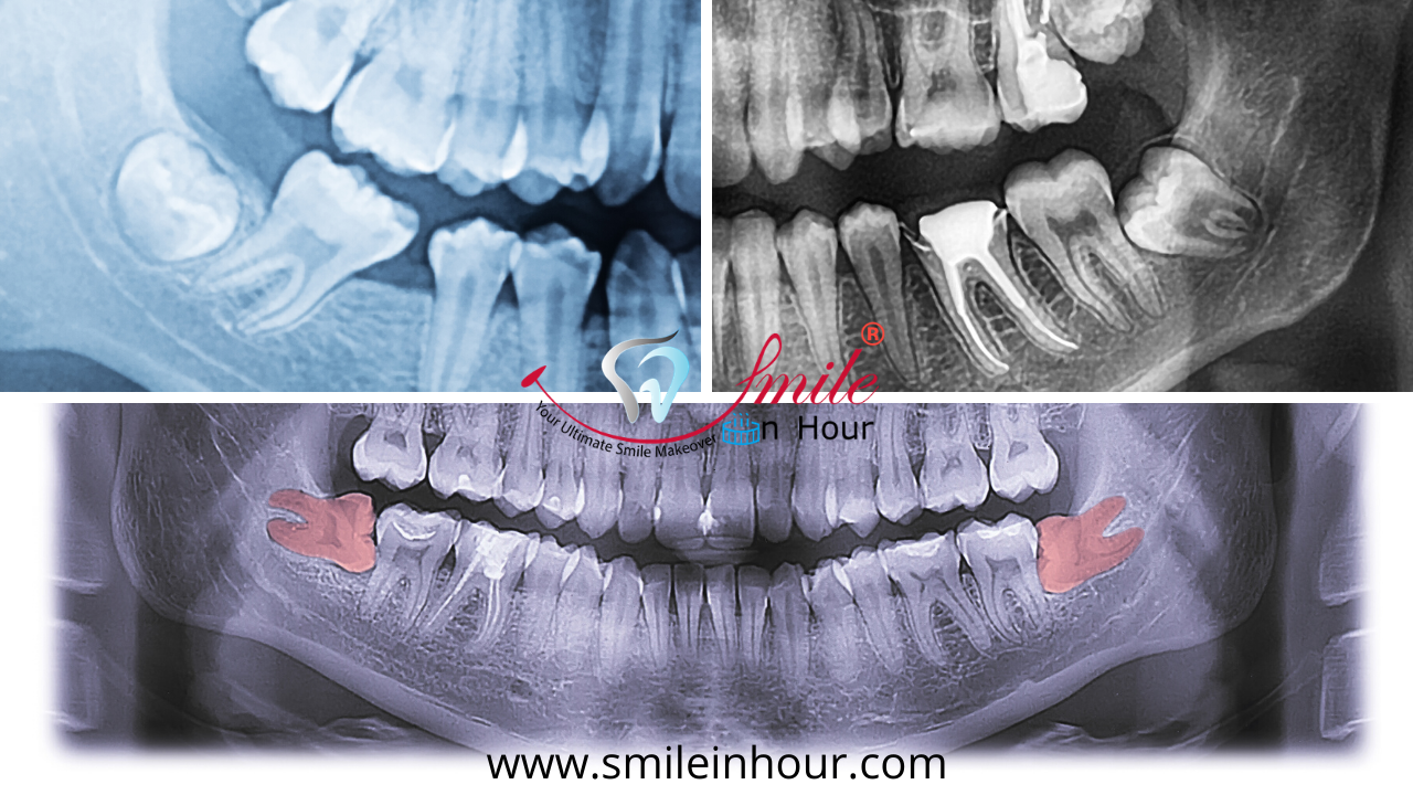 X Ray Types or removal Impacted Wisdom Tooth Smile in hour dentist best dental clinic Ahmedabad Mumbai New Delhi Chennai Kolkata Hyderabad India